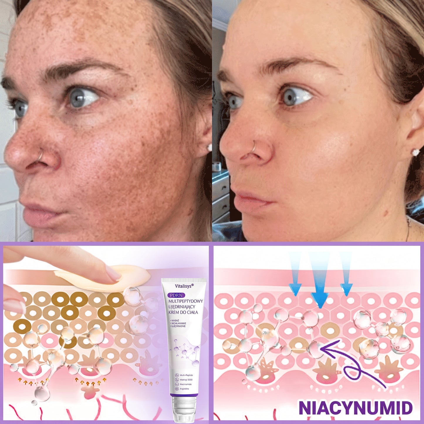 Polecany przez dermatologów🥇 |🍇 Vitalisys® PDRN Multi-Peptide Masujący Krem do Ciała – przeciwstarzeniowy, nawilżający, ujędrniający, regenerujący, wyrównujący koloryt, redukuje trądzik, przebarwienia, brodawki, znamiona i łuszczycę.❤️