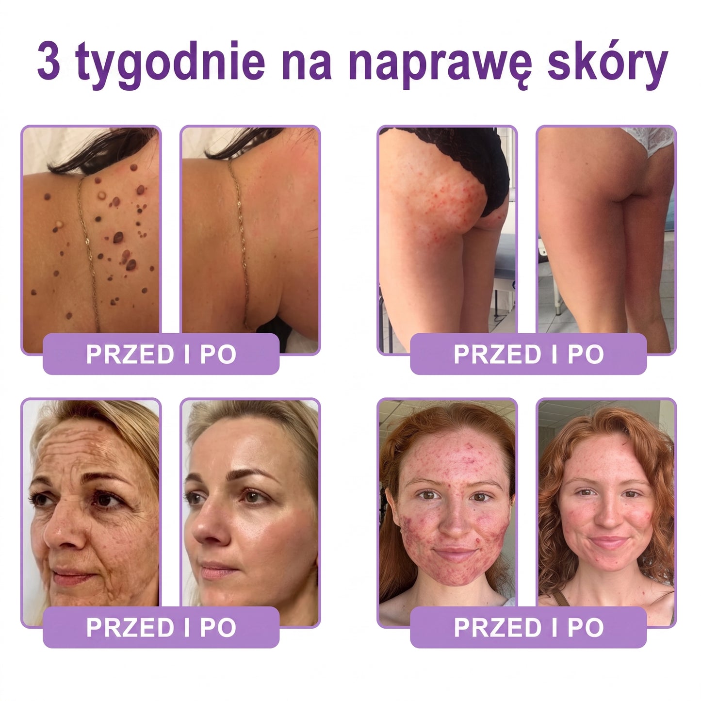 Polecany przez dermatologów🥇 |🍇 Vitalisys® PDRN Multi-Peptide Masujący Krem do Ciała – przeciwstarzeniowy, nawilżający, ujędrniający, regenerujący, wyrównujący koloryt, redukuje trądzik, przebarwienia, brodawki, znamiona i łuszczycę.❤️