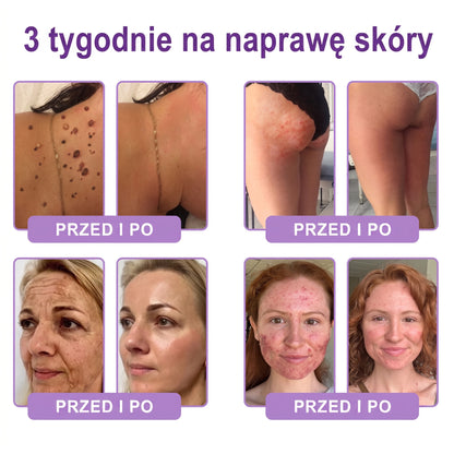 Polecany przez dermatologów🥇 |🍇 Vitalisys® PDRN Multi-Peptide Masujący Krem do Ciała – przeciwstarzeniowy, nawilżający, ujędrniający, regenerujący, wyrównujący koloryt, redukuje trądzik, przebarwienia, brodawki, znamiona i łuszczycę.❤️