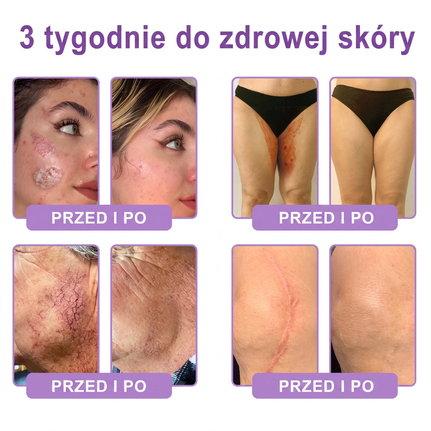 Polecany przez dermatologów🥇 |🍇 Vitalisys® PDRN Multi-Peptide Masujący Krem do Ciała – przeciwstarzeniowy, nawilżający, ujędrniający, regenerujący, wyrównujący koloryt, redukuje trądzik, przebarwienia, brodawki, znamiona i łuszczycę.❤️